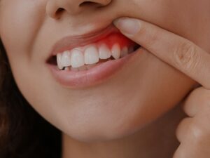 Receding Gum Treatment Staines